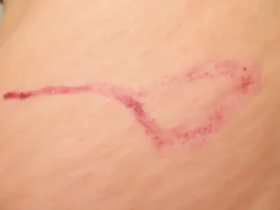 Świeże rozstępy: Jak wyglądają i jak je leczyć?