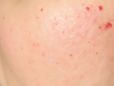 Laser frakcyjny – Jak wygląda zabieg i jego efekty?