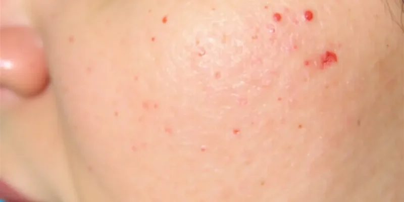 Laser frakcyjny – Jak wygląda zabieg i jego efekty?